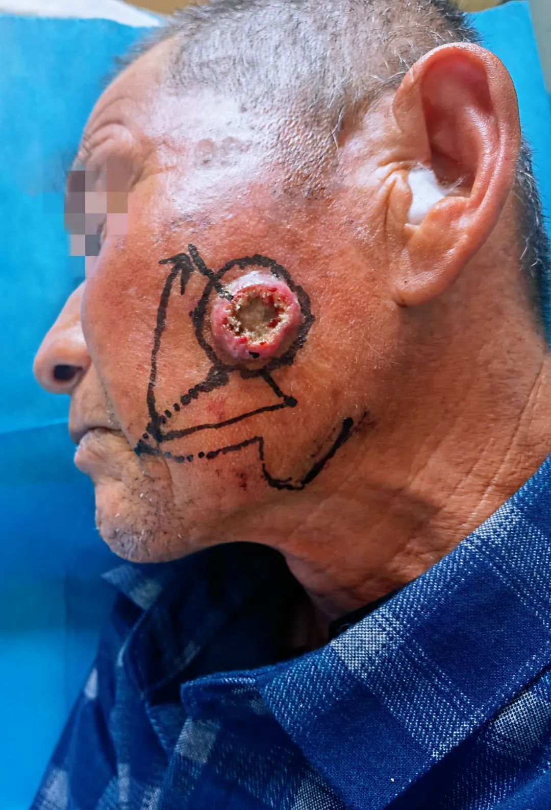 新技术府谷县中医院成功开展首例双叶易位皮瓣修复术